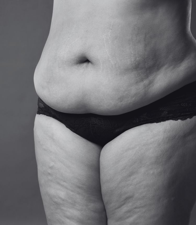 Image comparing mild and severe cellulite grades Whitstable