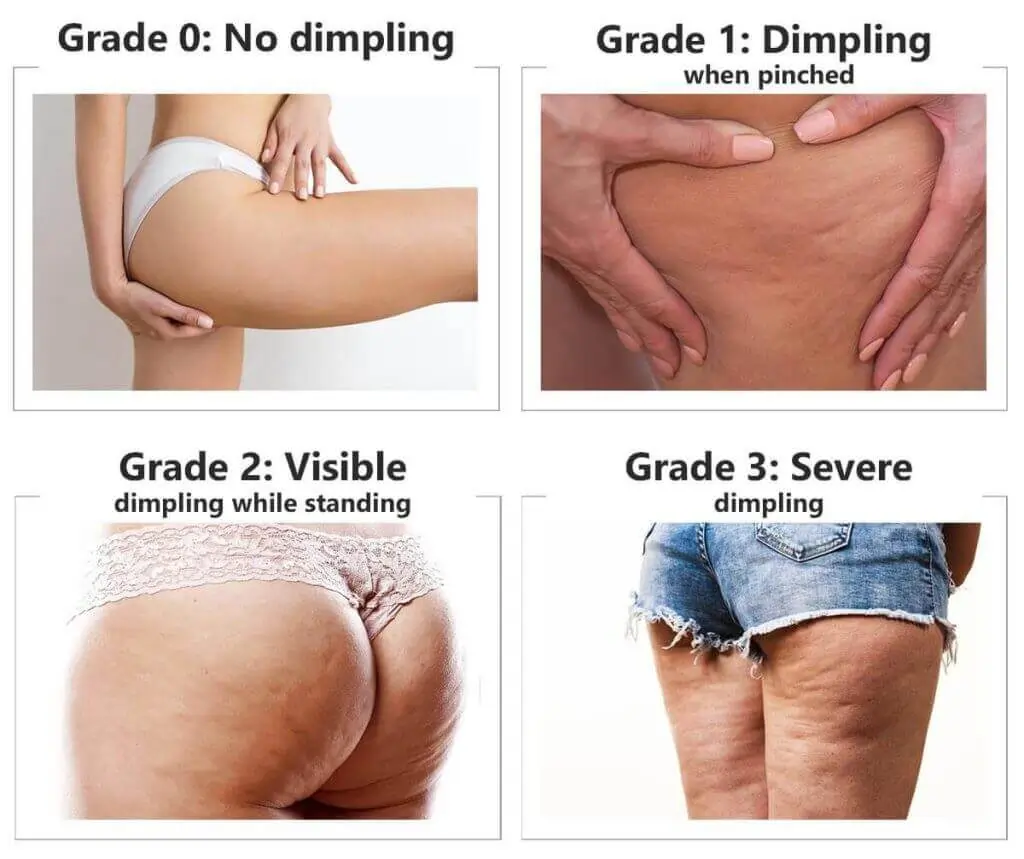 Representation of the stages of cellulite development Whitstable